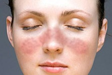 Concept Autoimmune Diseases