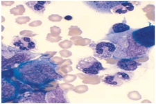 Concept Blood Diseases