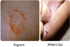 Concept Fungi and Human Disease