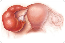 Concept Non-Infectious Reproductive System Disorders